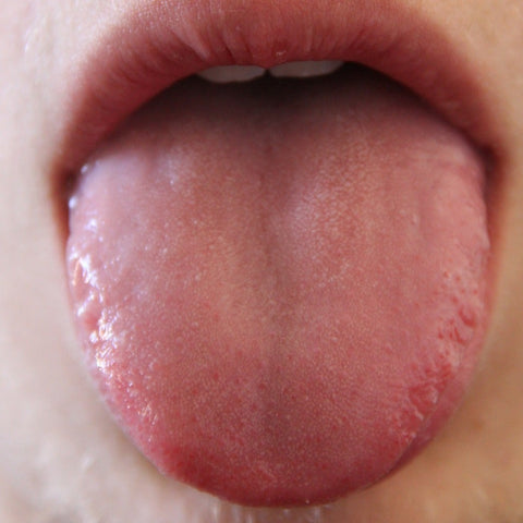 A Traditional East Asian Medicine Approach to: Tongue Diagnosis